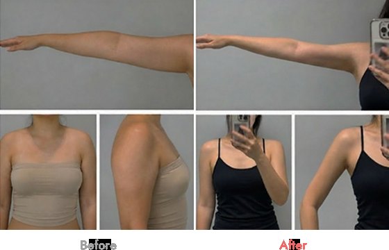 복부성형술 · 뱃살거상술 (Abdominoplasty (Tummy Tuck)) 안내 이미지 - 강남 서울 셀이즈랩의원